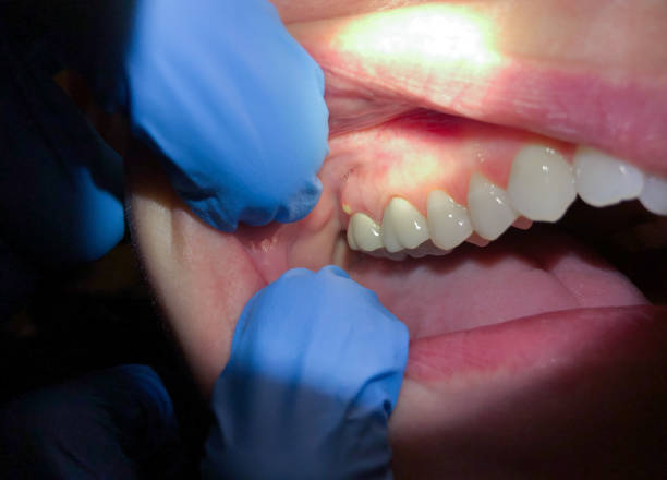 Best Emergency Dentist for Knocked-Out Tooth in Swartz Creek, MI
