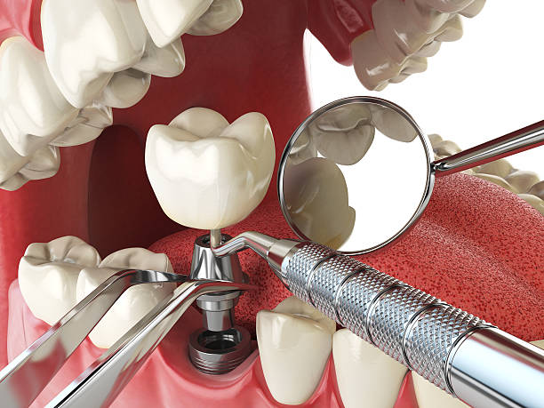 Best Emergency Root Canal Treatment in Swartz Creek, MI